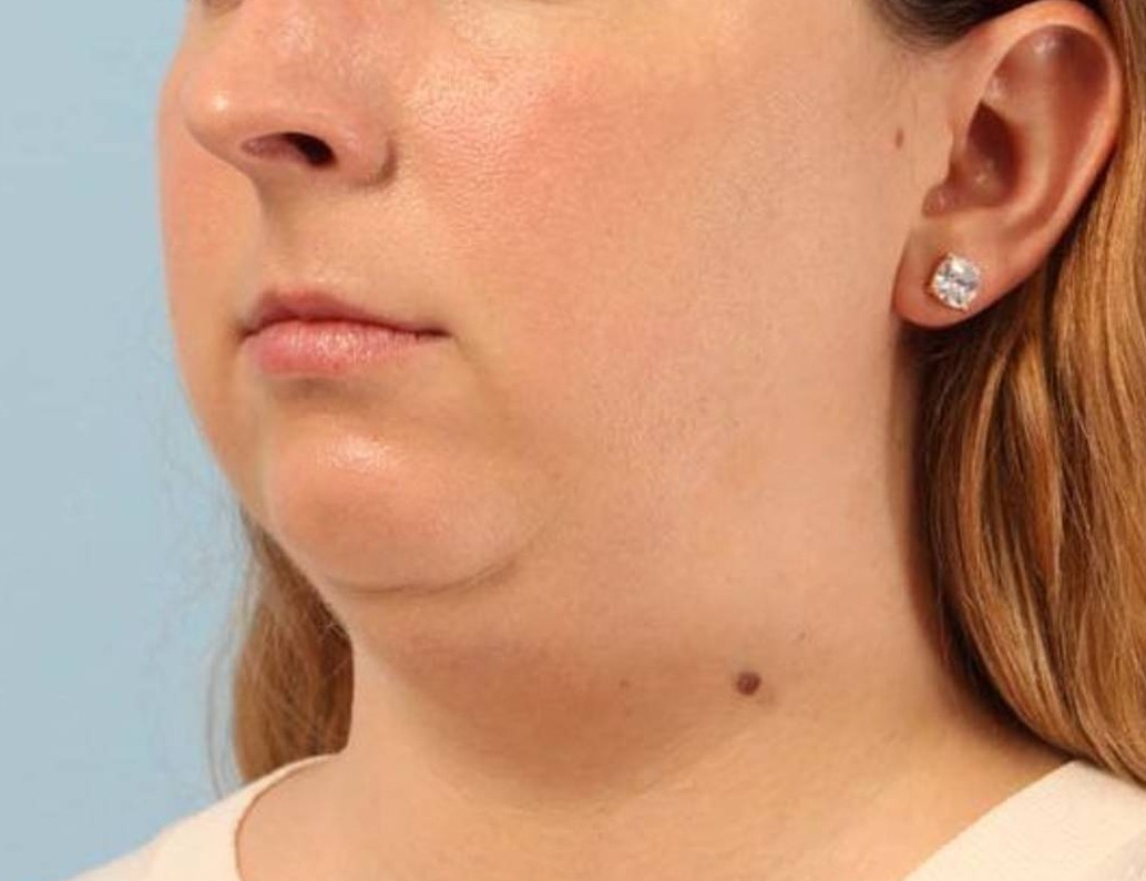 Augmentation Genioplasty Before & After Image