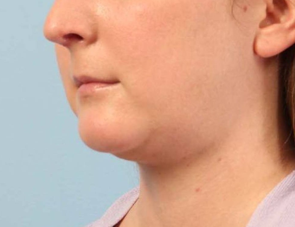 Augmentation Genioplasty Before & After Image