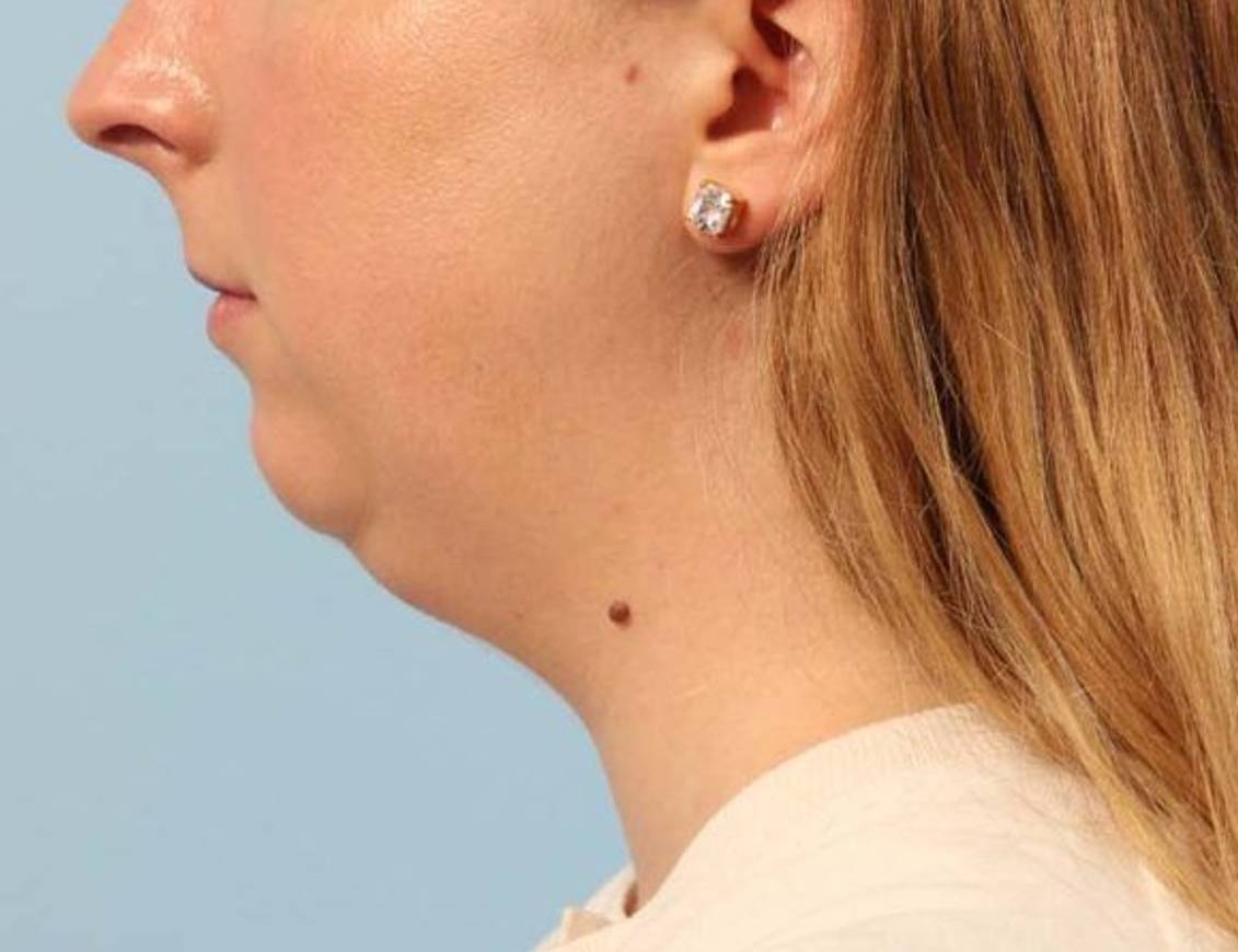 Augmentation Genioplasty Before & After Image