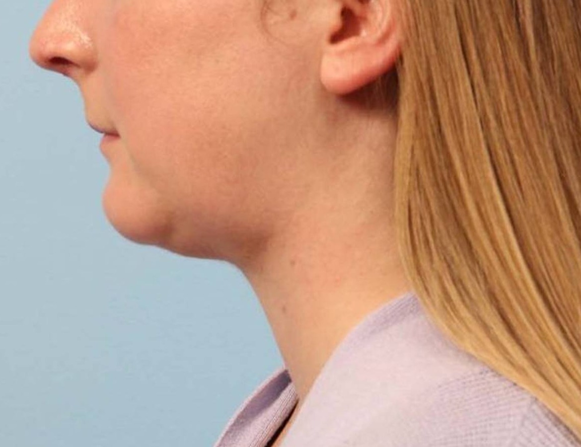 Augmentation Genioplasty Before & After Image