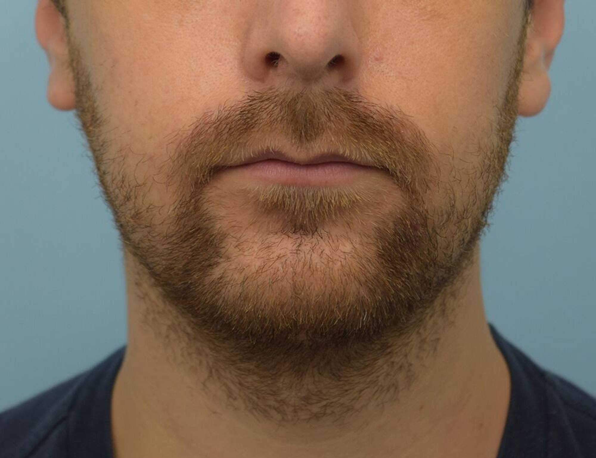 Augmentation Genioplasty Before & After Image