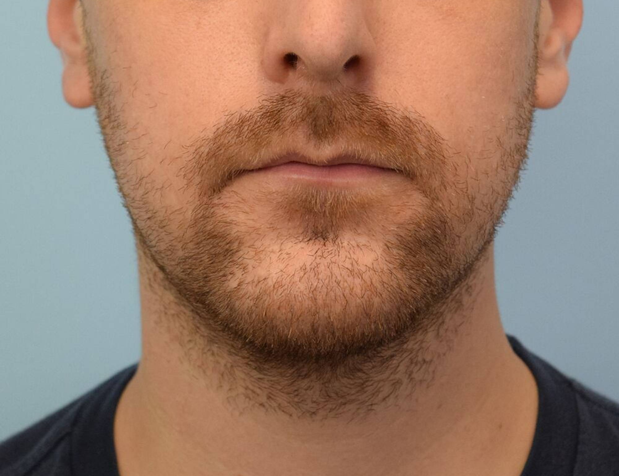 Augmentation Genioplasty Before & After Image