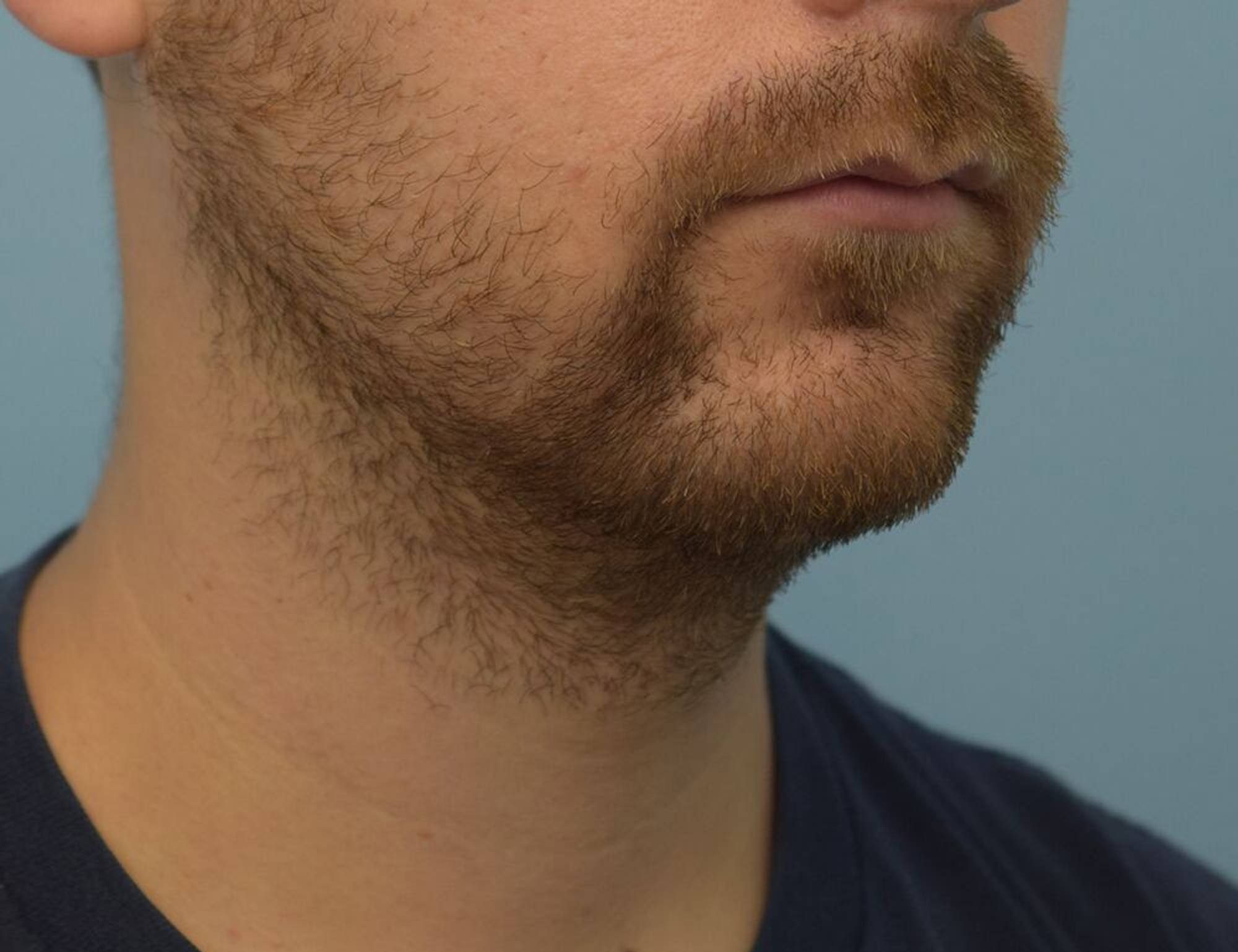 Augmentation Genioplasty Before & After Image
