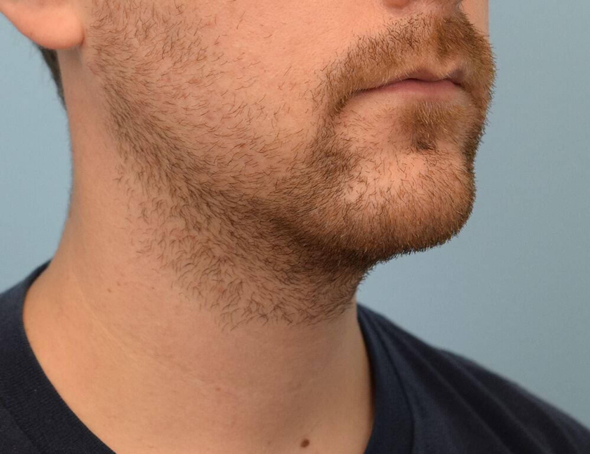 Augmentation Genioplasty Before & After Image