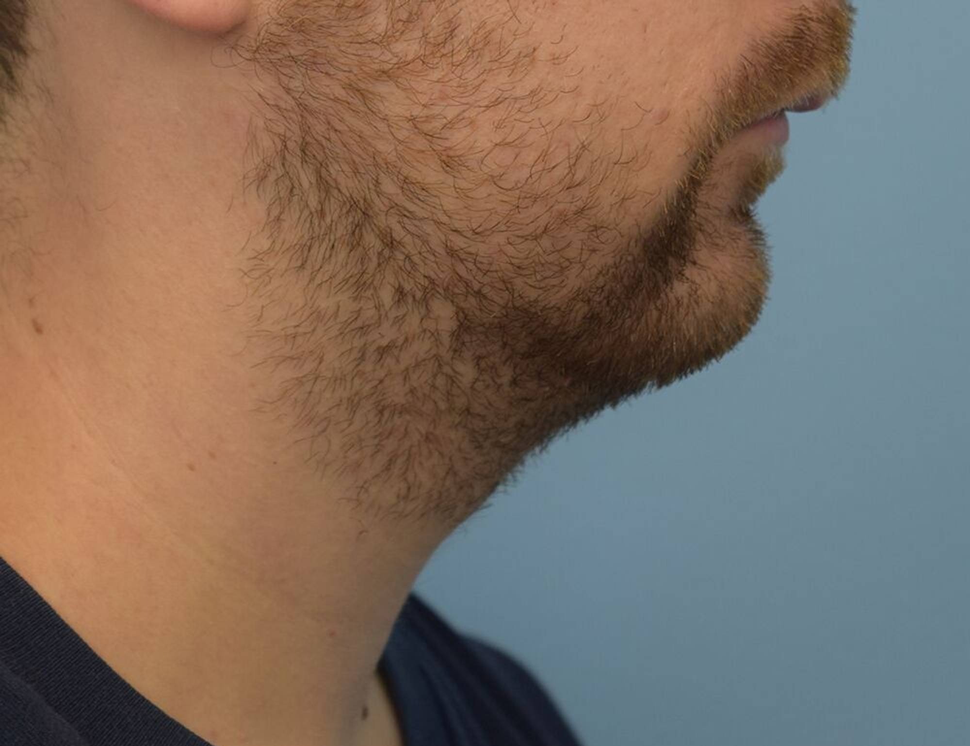 Augmentation Genioplasty Before & After Image