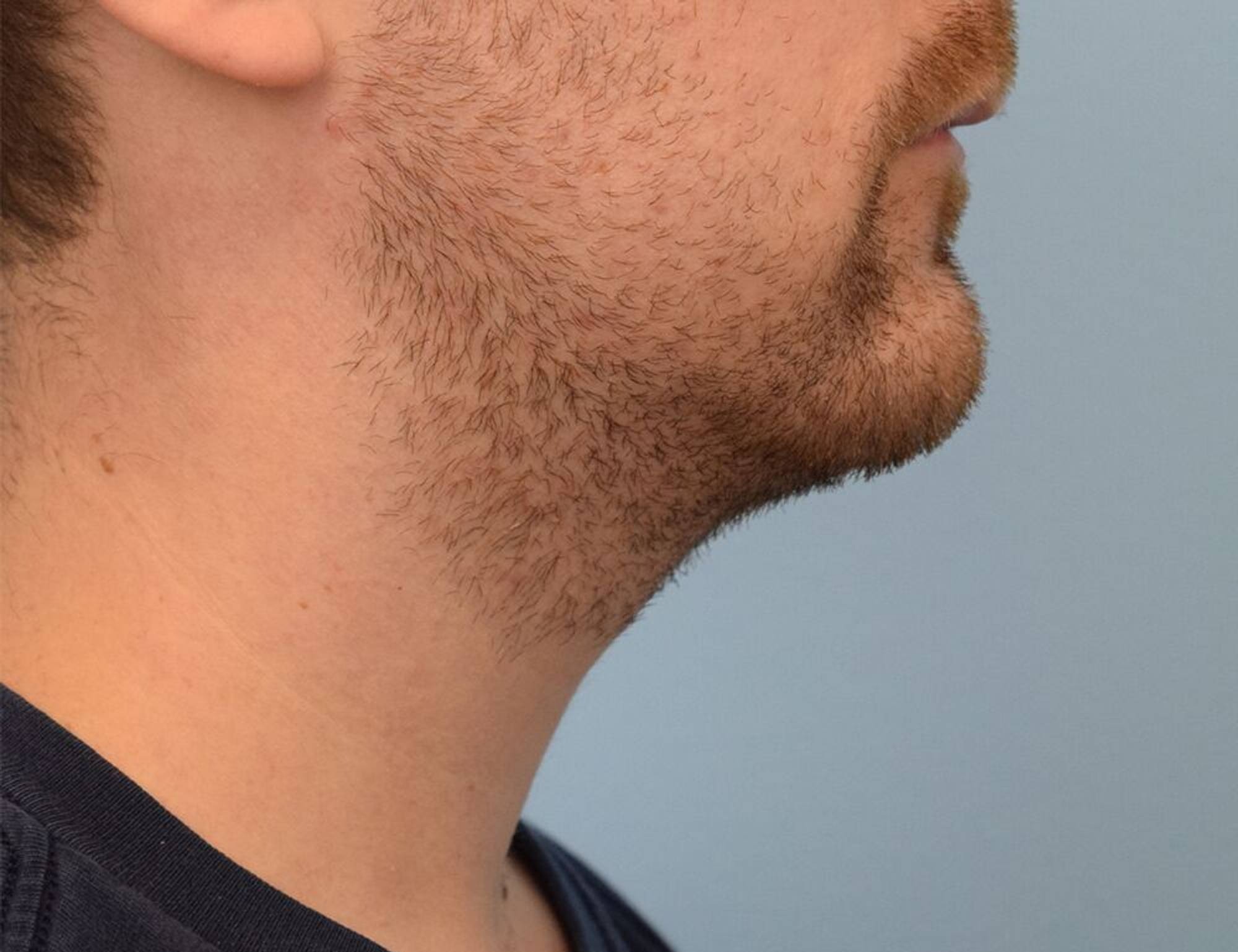 Augmentation Genioplasty Before & After Image