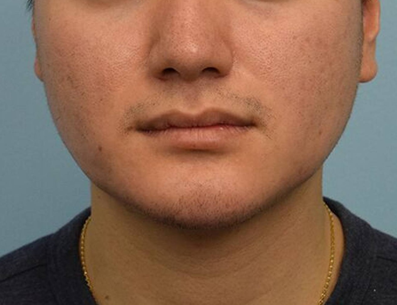 Augmentation Genioplasty Before & After Image