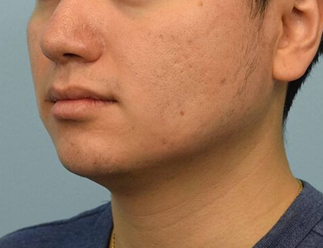 Augmentation Genioplasty Before & After Image