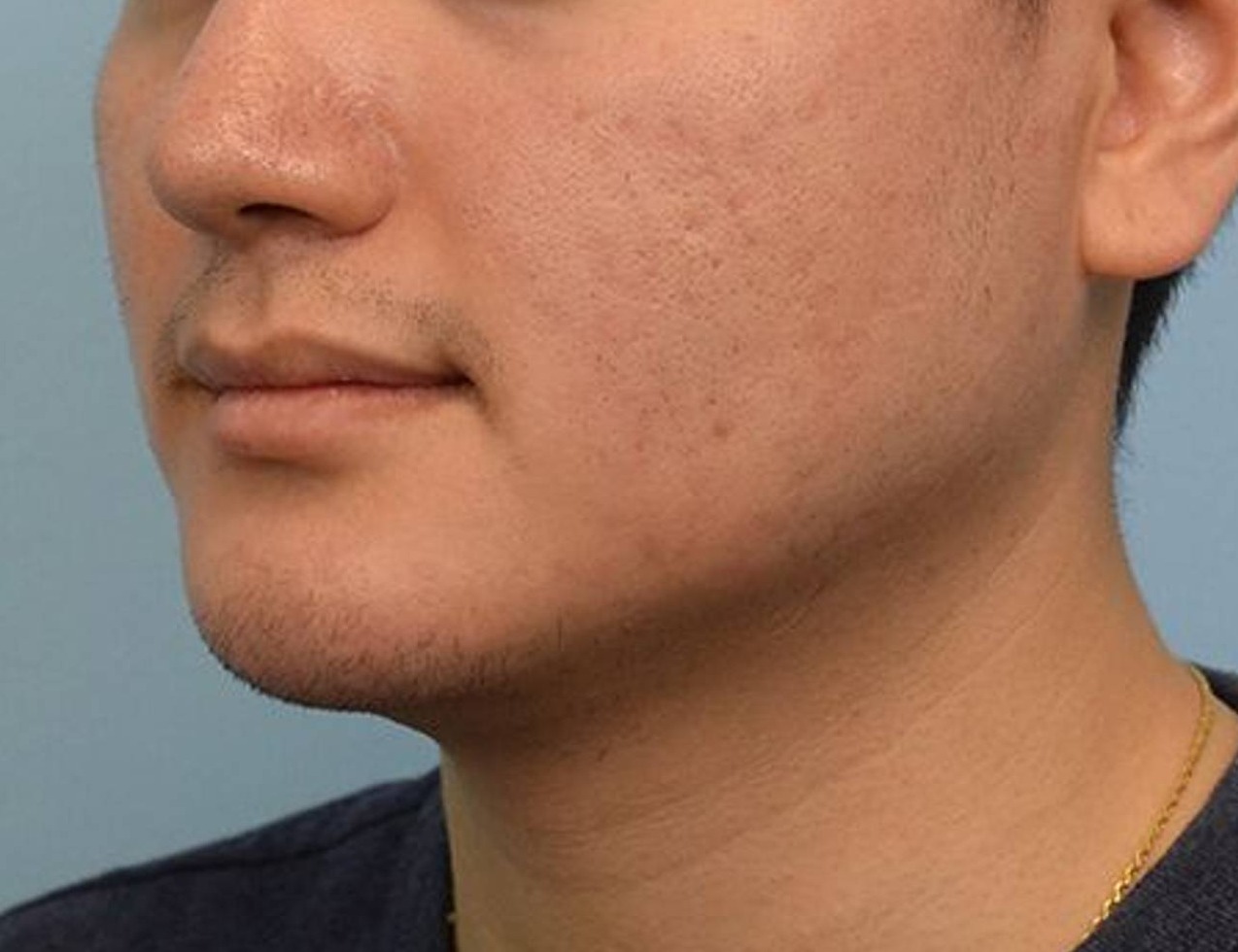 Augmentation Genioplasty Before & After Image