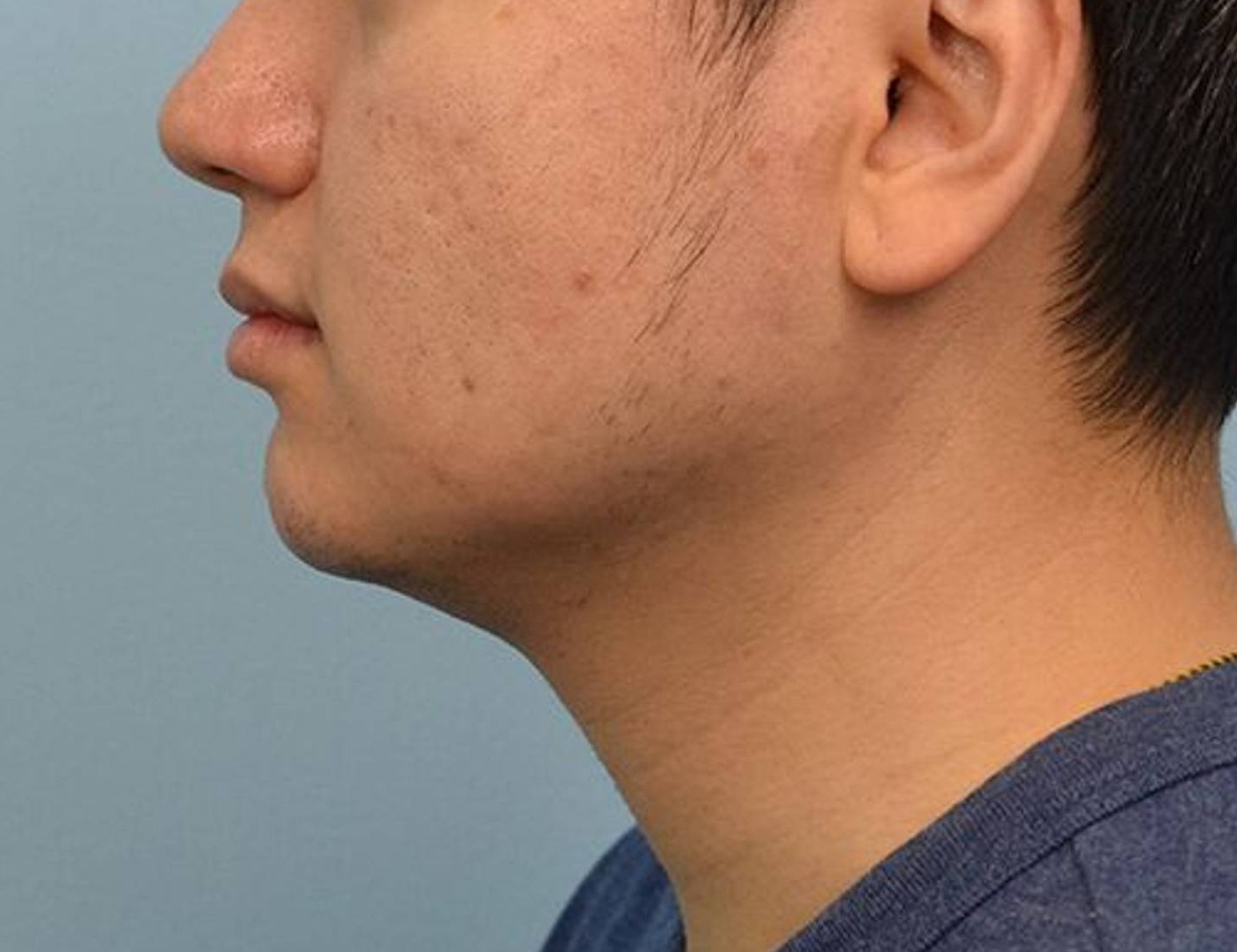 Augmentation Genioplasty Before & After Image