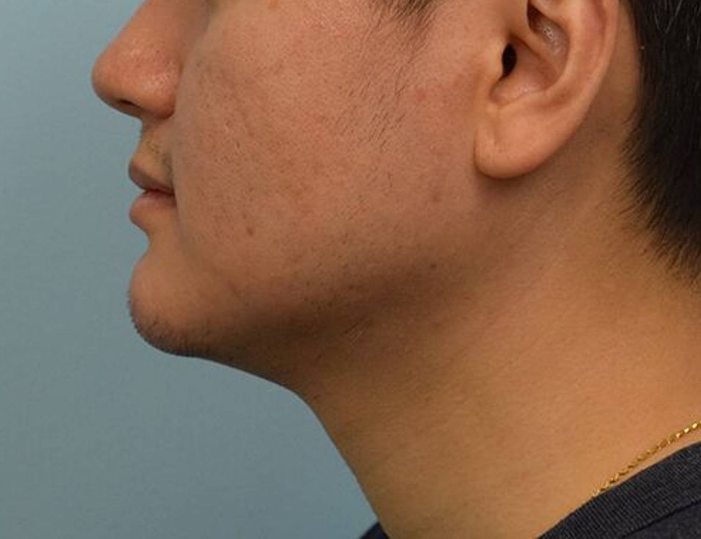 Augmentation Genioplasty Before & After Image