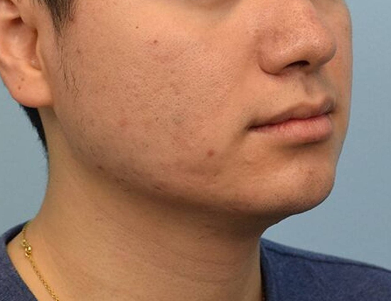 Augmentation Genioplasty Before & After Image