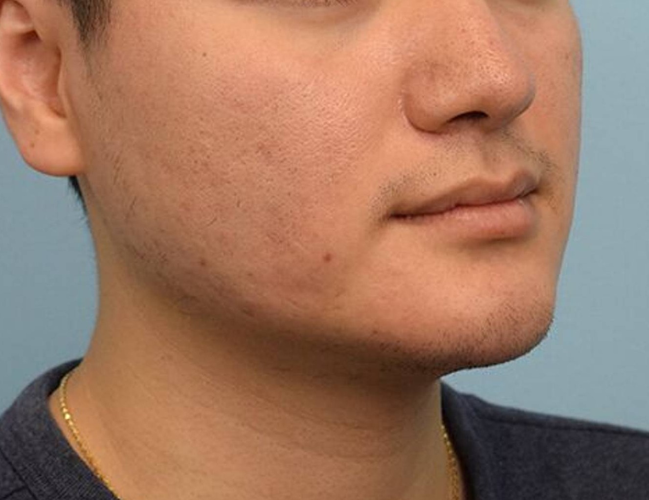 Augmentation Genioplasty Before & After Image