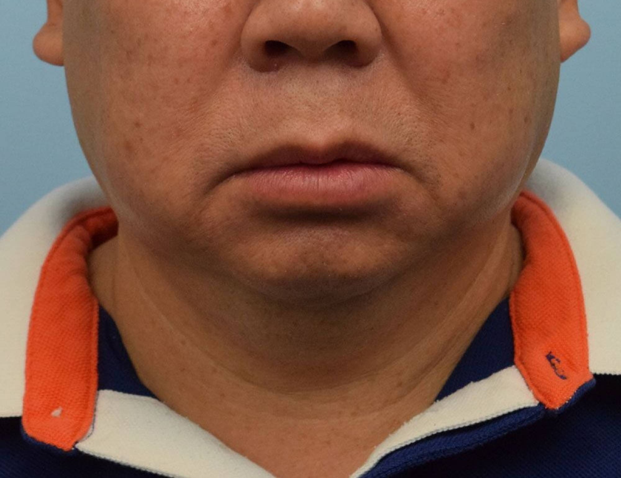 Augmentation Genioplasty Before & After Image
