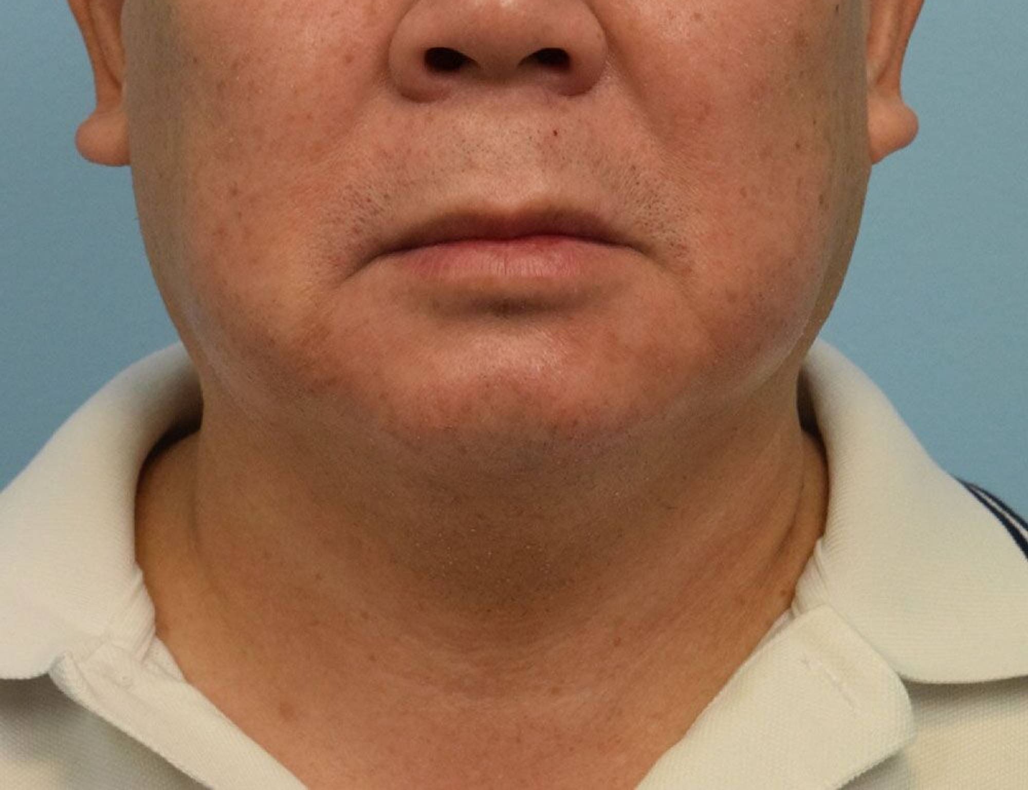 Augmentation Genioplasty Before & After Image