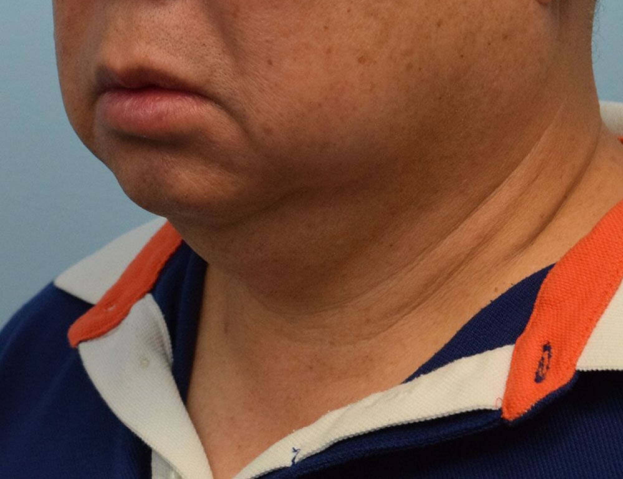 Augmentation Genioplasty Before & After Image