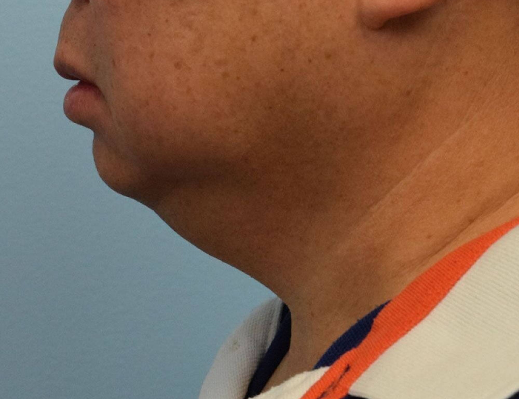 Augmentation Genioplasty Before & After Image