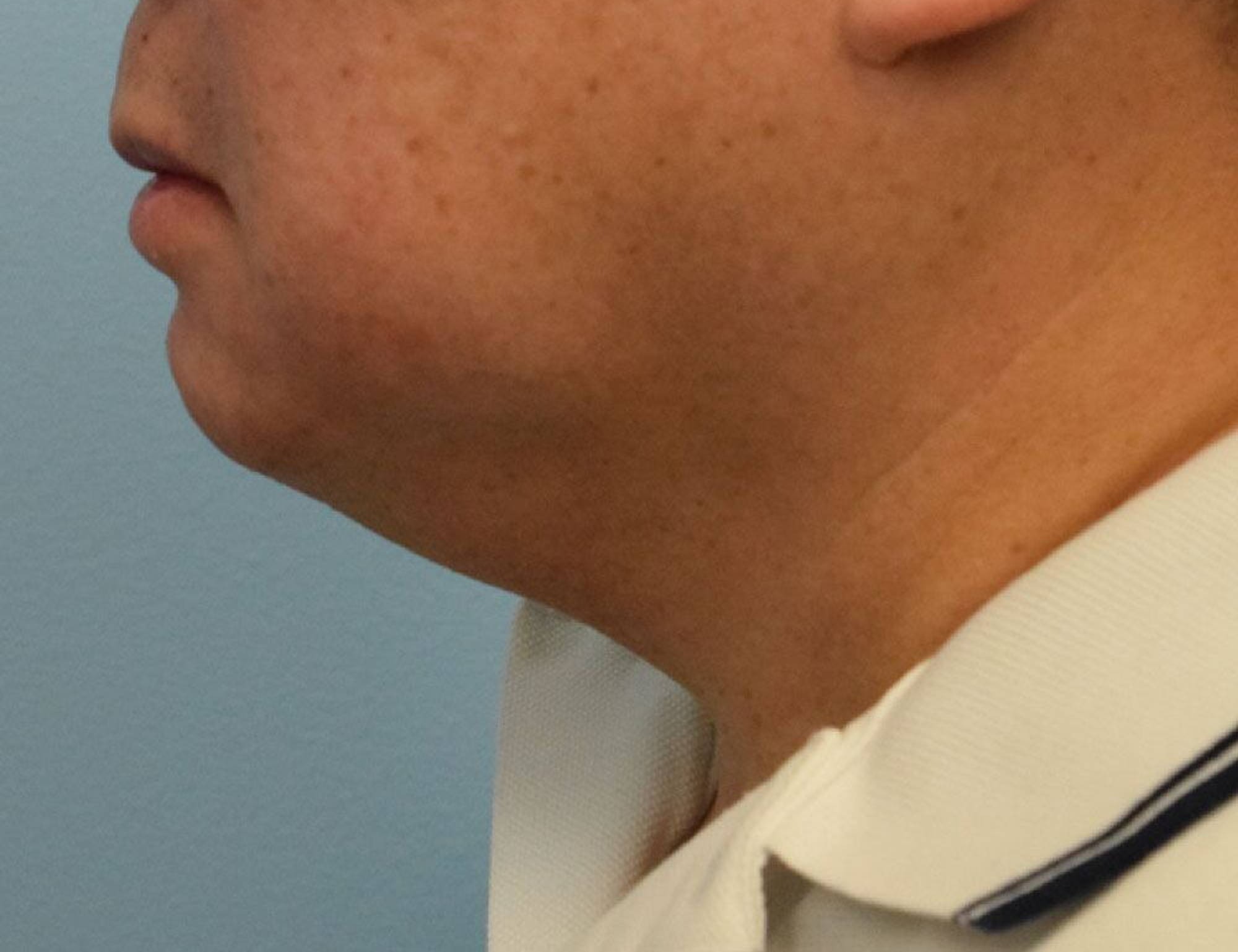 Augmentation Genioplasty Before & After Image