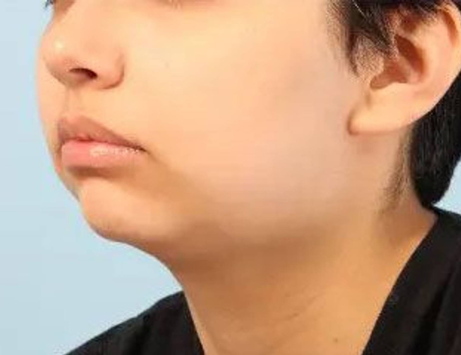 Augmentation Genioplasty Before & After Image