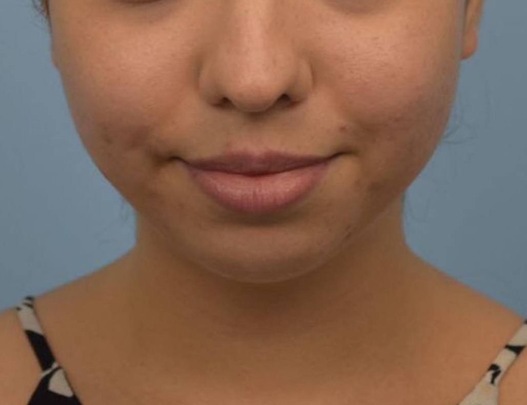 Augmentation Genioplasty Before & After Image