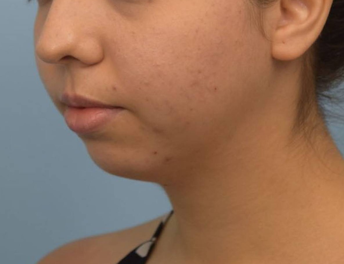 Augmentation Genioplasty Before & After Image