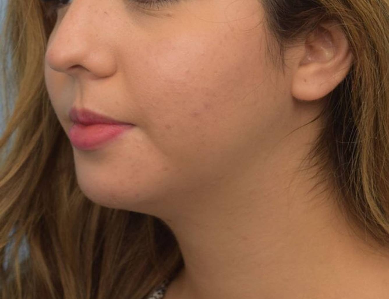 Augmentation Genioplasty Before & After Image