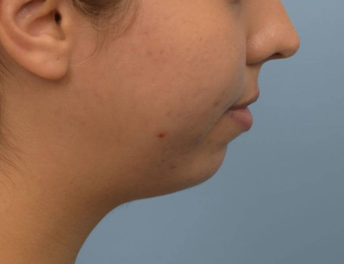 Augmentation Genioplasty Before & After Image