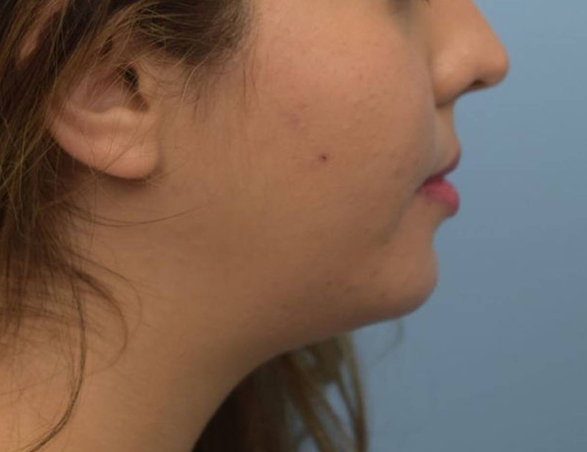 Augmentation Genioplasty Before & After Image
