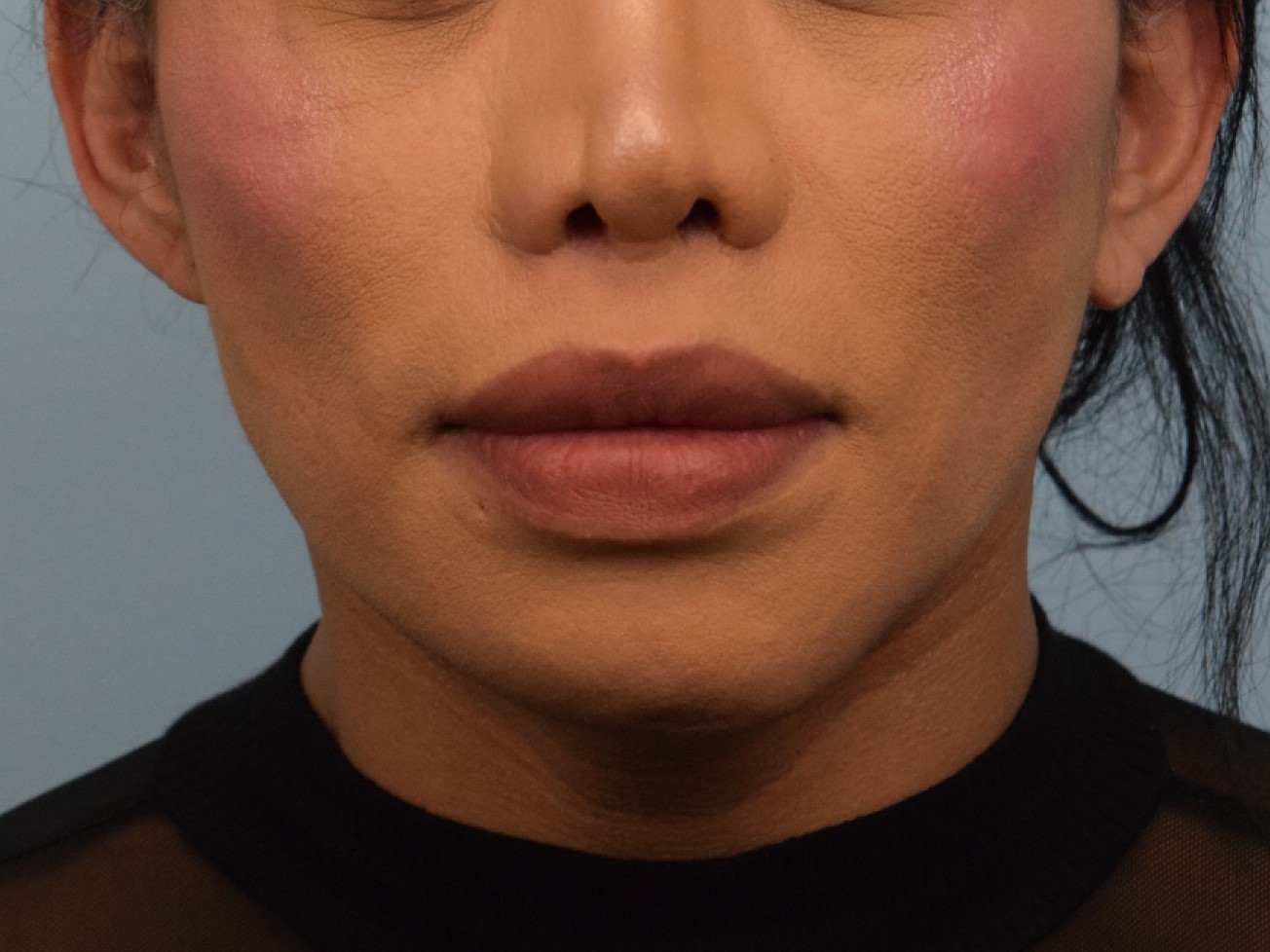 Augmentation Genioplasty Before & After Image