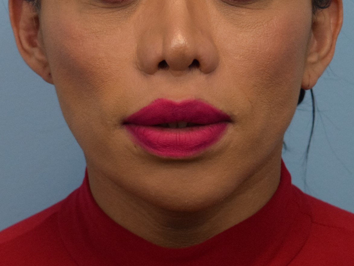 Augmentation Genioplasty Before & After Image