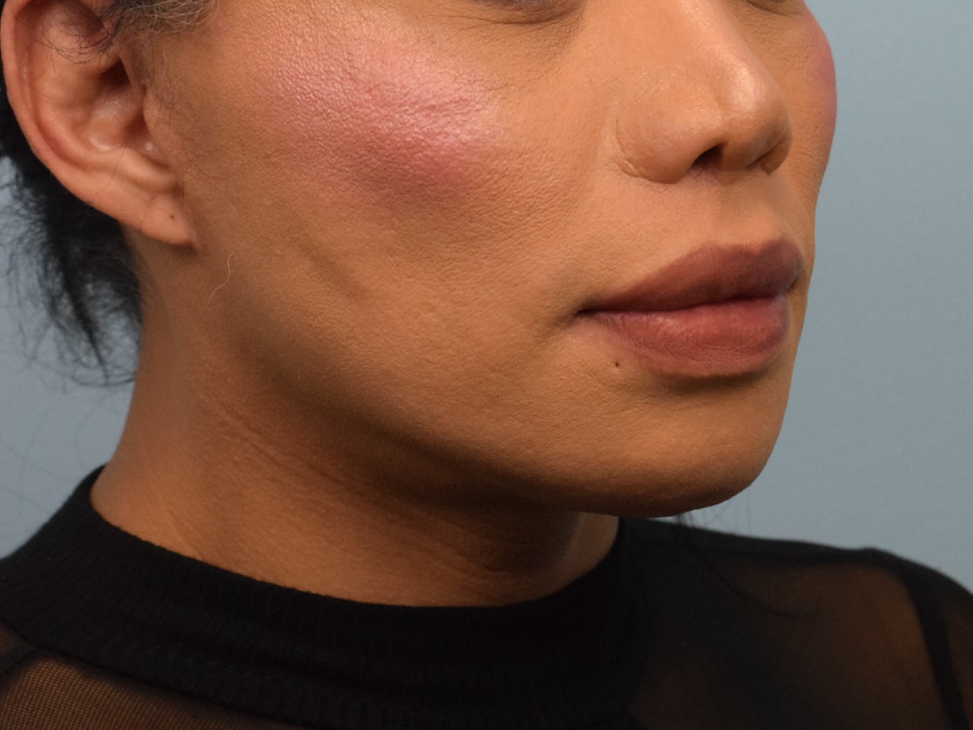Augmentation Genioplasty Before & After Image