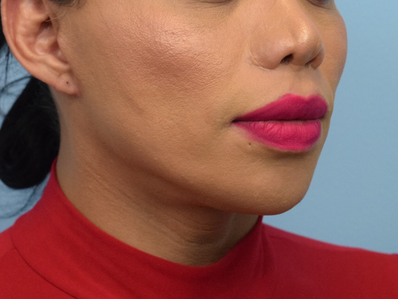 Augmentation Genioplasty Before & After Image
