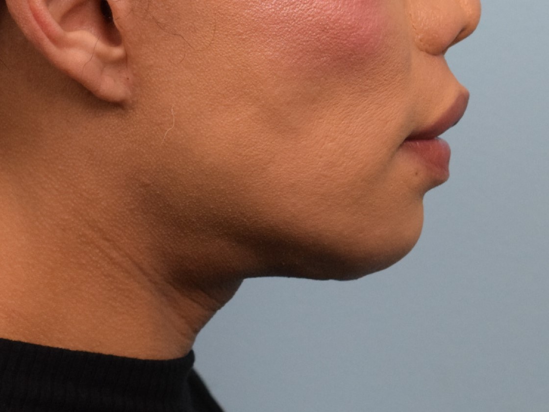 Augmentation Genioplasty Before & After Image