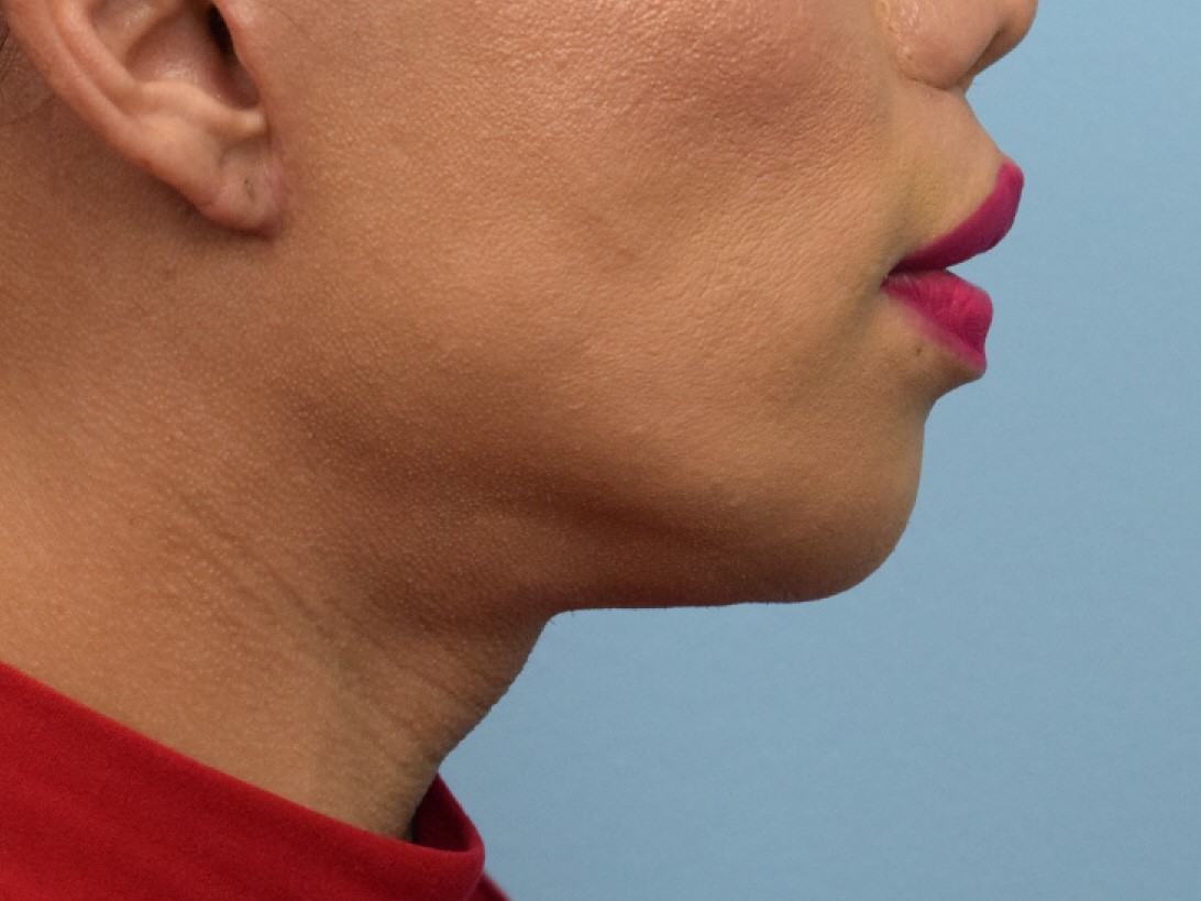 Augmentation Genioplasty Before & After Image