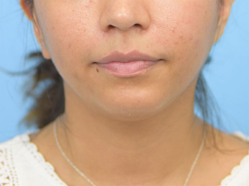 Augmentation Genioplasty Before & After Image