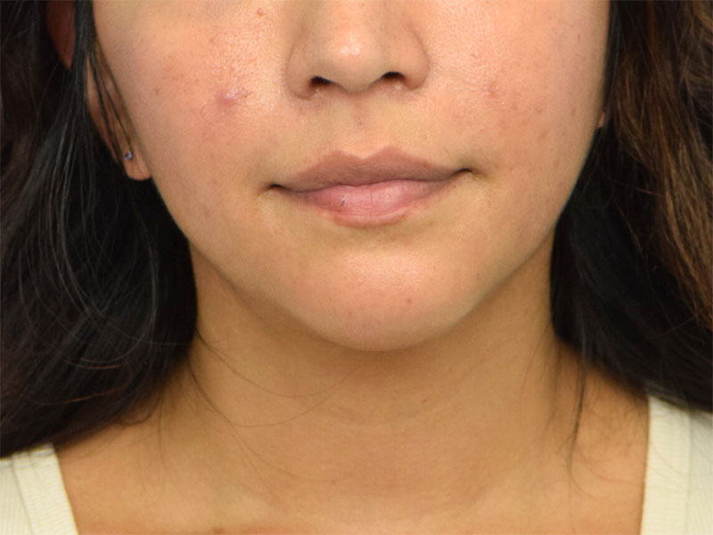 Augmentation Genioplasty Before & After Image