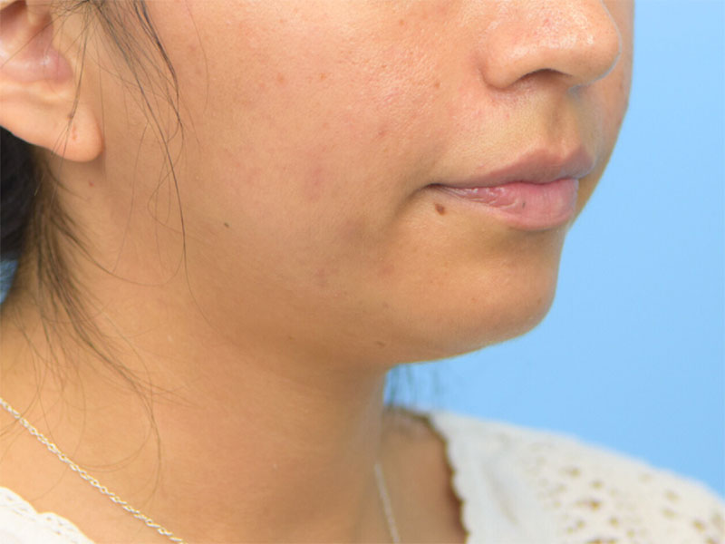 Augmentation Genioplasty Before & After Image