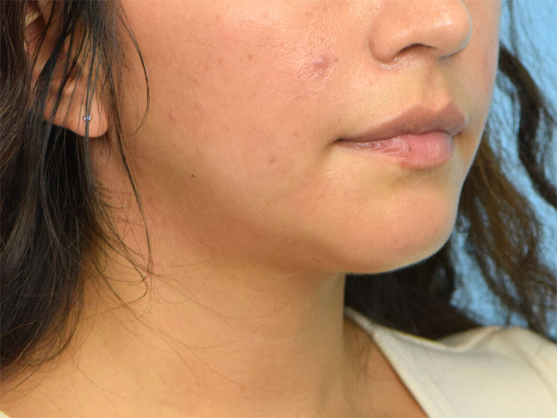 Augmentation Genioplasty Before & After Image