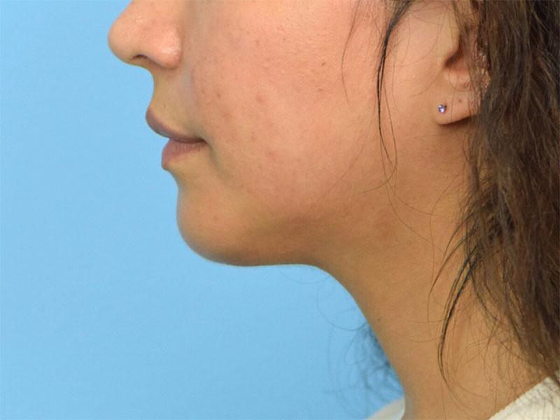 Augmentation Genioplasty Before & After Image