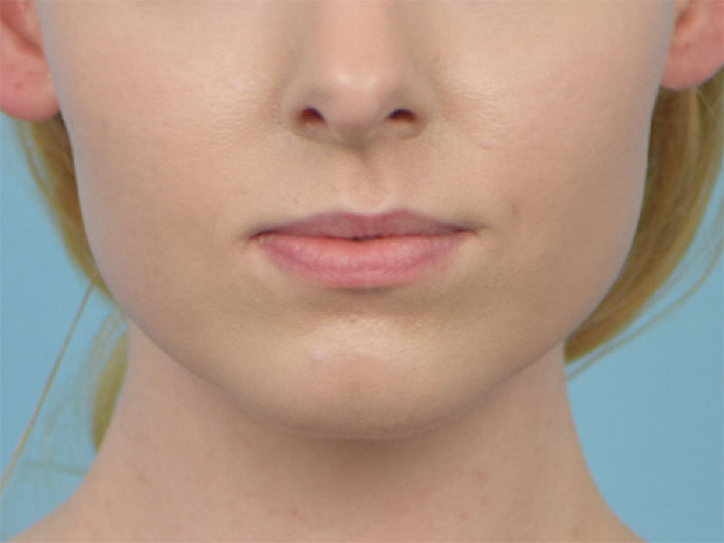 Augmentation Genioplasty Before & After Image
