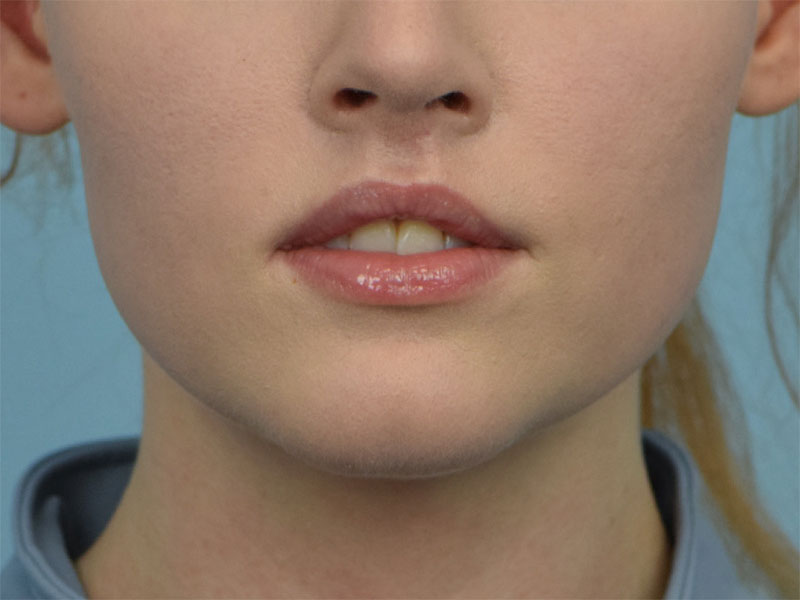 Augmentation Genioplasty Before & After Image