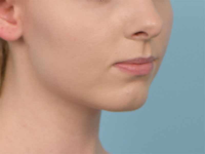 Augmentation Genioplasty Before & After Image
