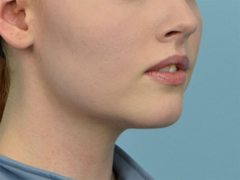 Augmentation Genioplasty Before & After Image
