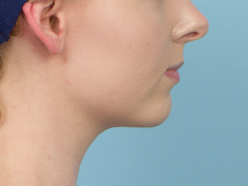 Augmentation Genioplasty Before & After Image
