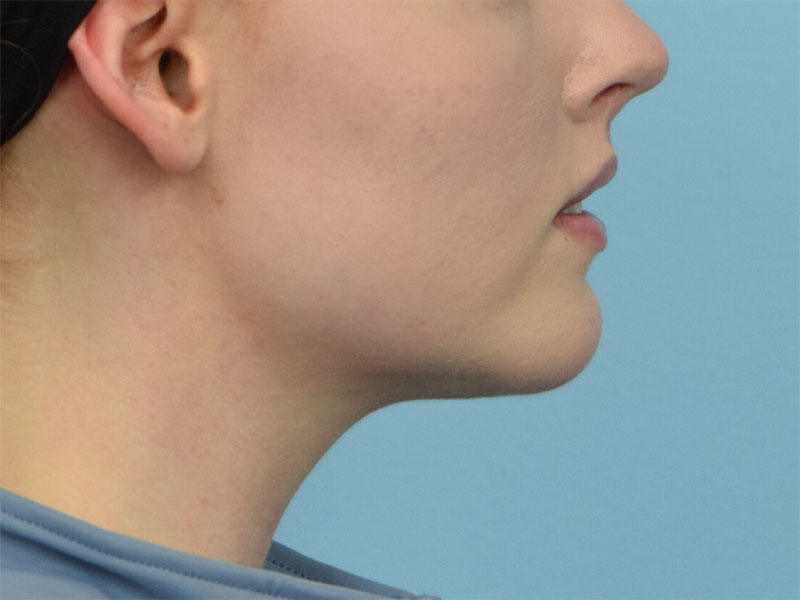 Augmentation Genioplasty Before & After Image