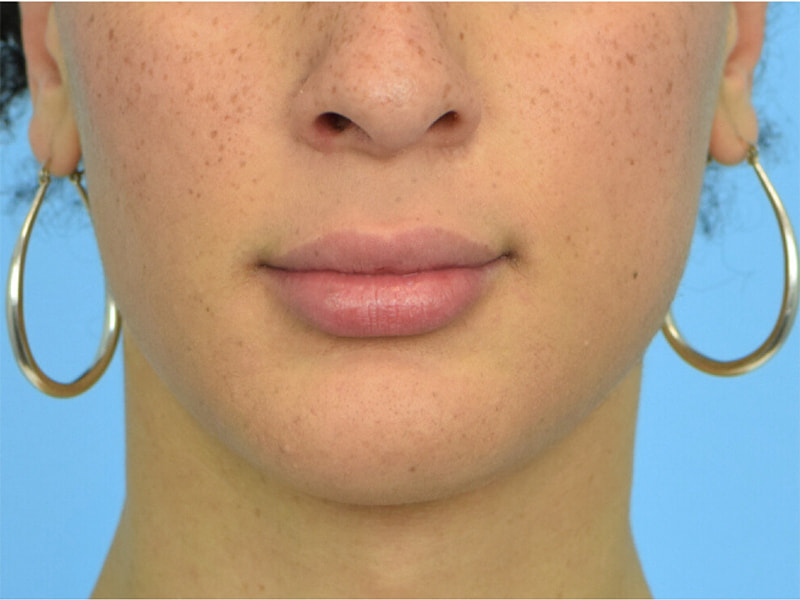 Augmentation Genioplasty Before & After Image