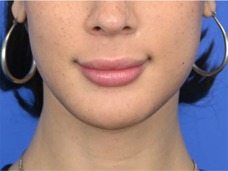 Augmentation Genioplasty Before & After Image