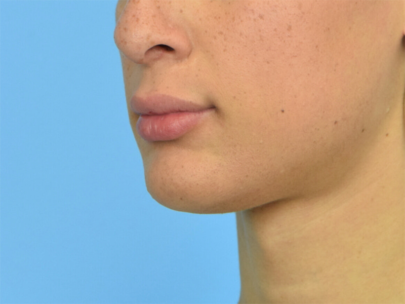 Augmentation Genioplasty Before & After Image