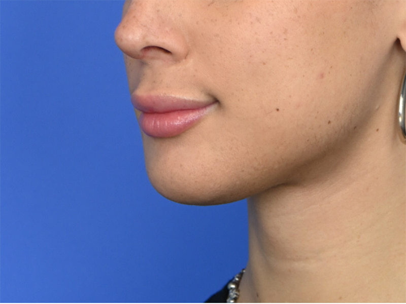 Augmentation Genioplasty Before & After Image