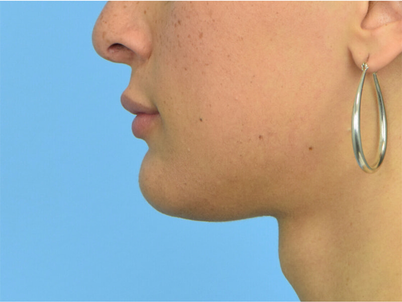Augmentation Genioplasty Before & After Image